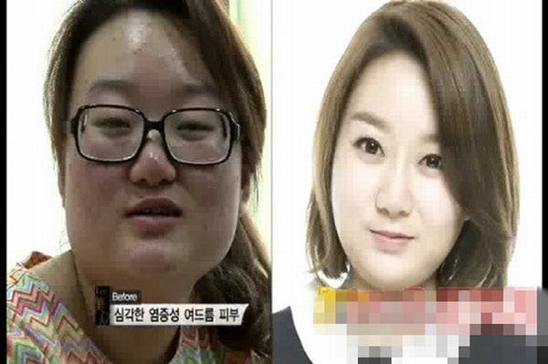 얼굴성형후 반전외모 충격